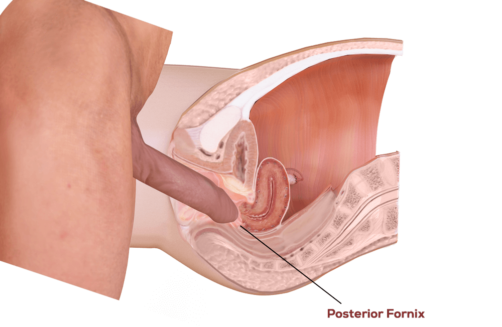 Bladder urogynaecology prolapse